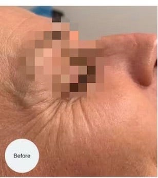 ダーマペン4の症例写真・画像・ビフォーアフター美容整形・美容外科のTAクリニックグループ