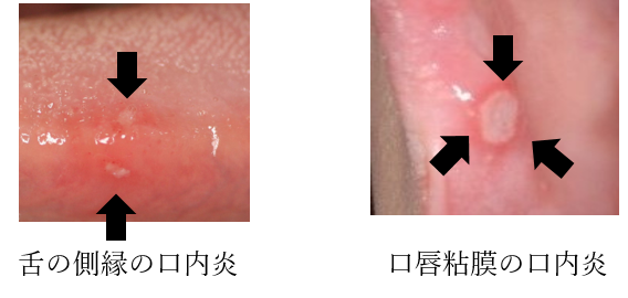口内炎の症状・原因くすりと健康の情報局