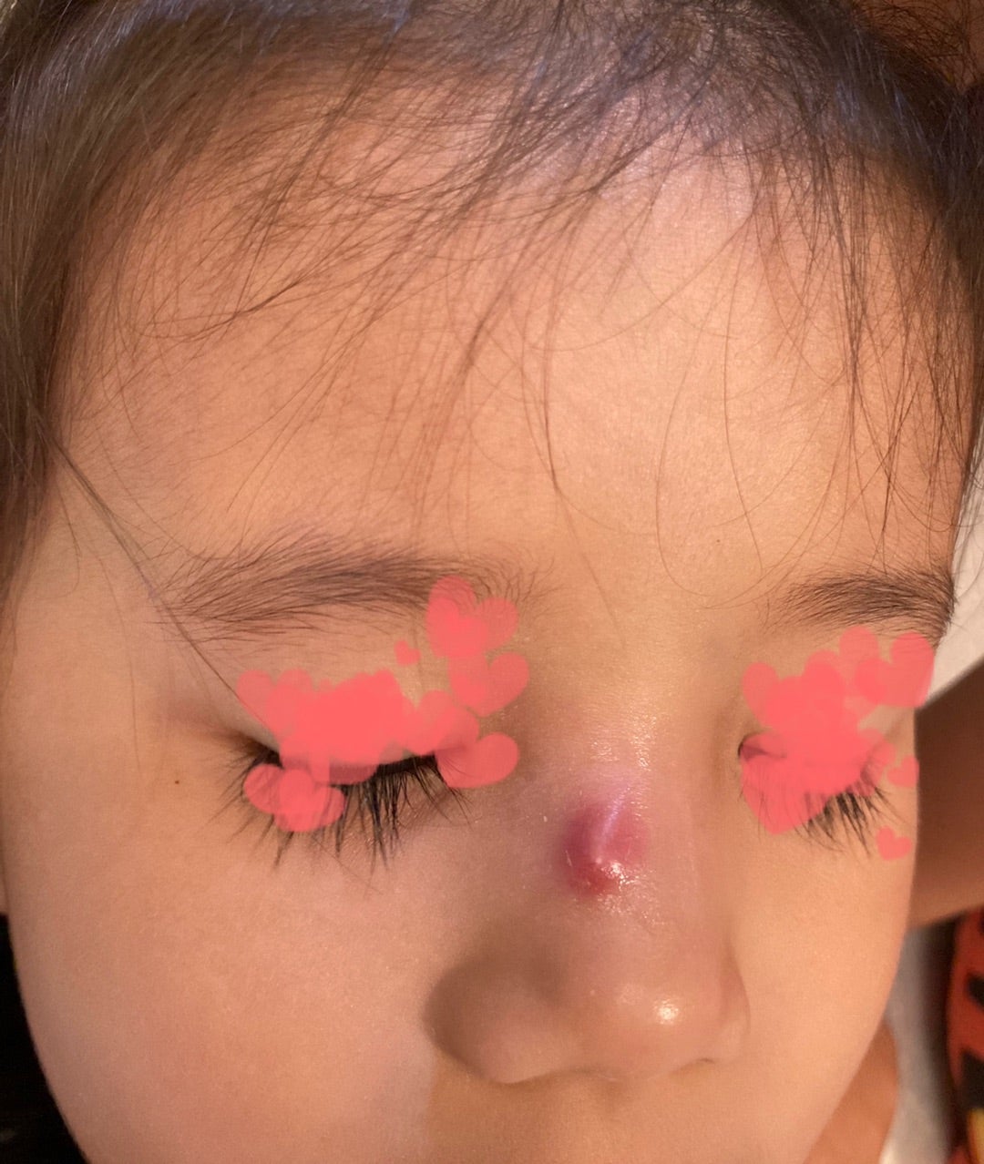 鼻周りの小さなプツプツ - 以前にも質問したのですがもう一度 Q&A - @cosme アットコスメ