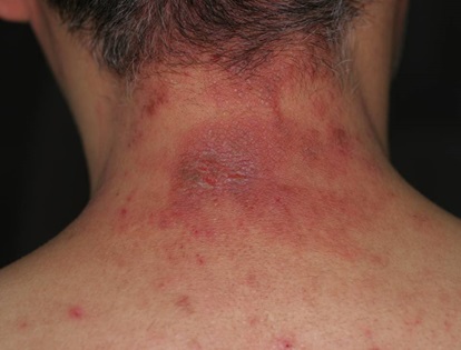 薬剤師が解説 首のかぶれにおすすめの市販薬はどれ？9選を紹介 – EPARKくすりの窓口コラムヘルスケア情報