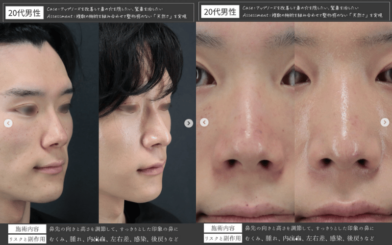 小鼻を小さくするためのメイク・筋トレ・スキンケアの方法