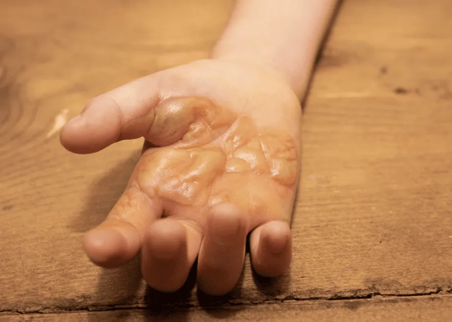 熱傷武蔵小山皮フ科形成外科