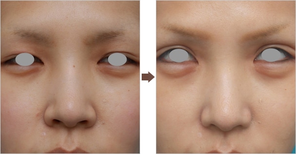 セルフケア ２週間で鼻の穴を小さくする方法！ 鼻の穴を縦長に- YouTube