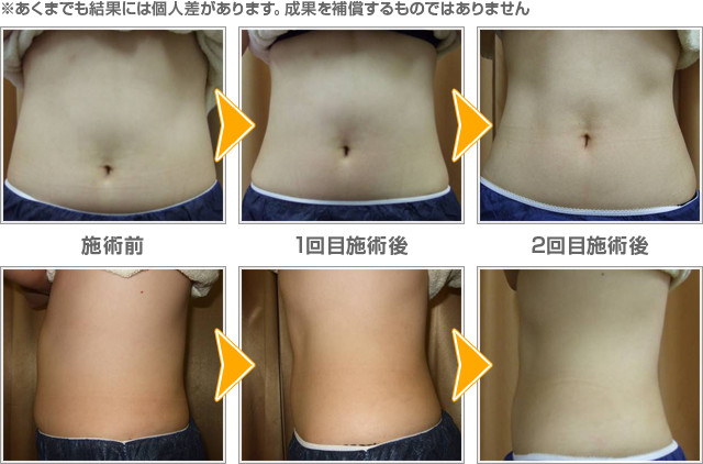 キャビテーション・ラジオ波・EMS＆リンパマッサージ - Nalu ナルー 錦糸町