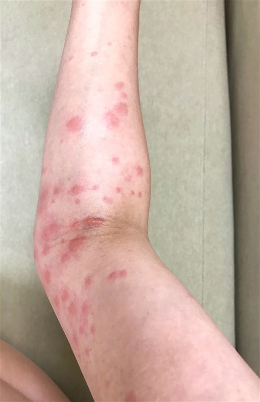 画像あり 毛虫に刺された跡の特徴│虫の駆除方法も解説 - くらしのマーケットマガジン