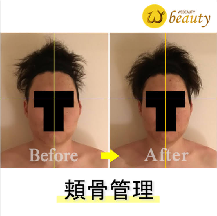 受け口とは？原因や治療 矯正・手術 、自力でできる治し方について輪郭形成・小顔整形 コラム池袋の小顔整形・顔痩せ・輪郭整形みずほクリニック