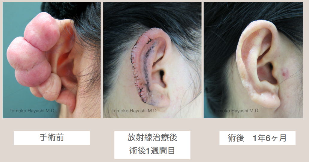 肥厚性瘢痕・ケロイド、傷跡形成、切り傷・やけどのご相談は、池袋の「松下皮フ形成外科」へ