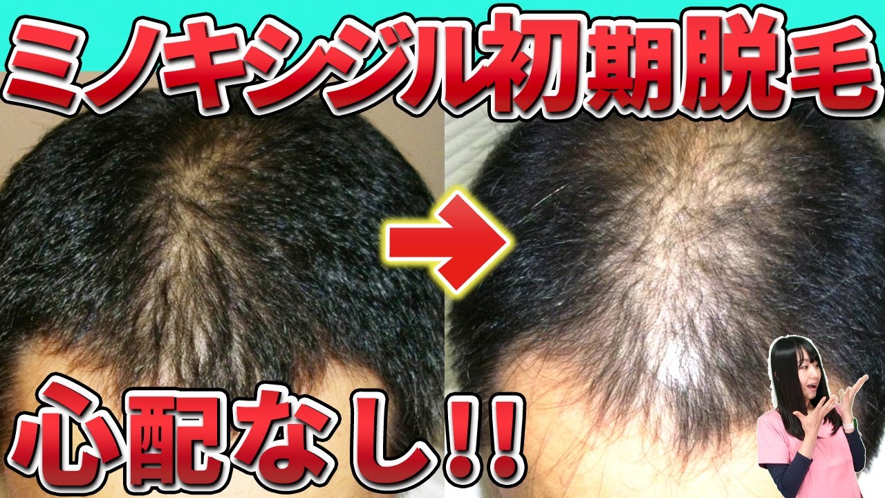 AGA患者様40歳男性 H-NⅢ型駅前AGAクリニック 新宿、北千住、大阪、京都、岡山、鹿児島など