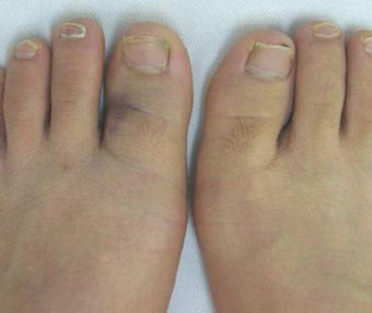 打撲 - ことぶき接骨院