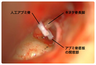 耳硬化症みんなの医療ガイド兵庫医科大学病院