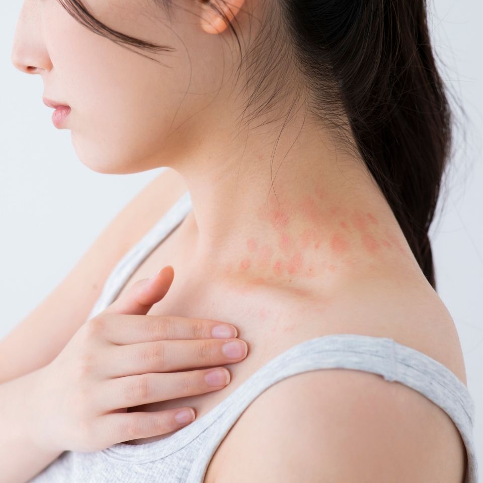 大小不同の赤い湿疹野田市 小児科 千葉県 こどもの花粉症 こどもの漢方 喘息 アトピー性皮膚炎 アレルギー 結節性痒疹 たんぽぽこどもクリニック