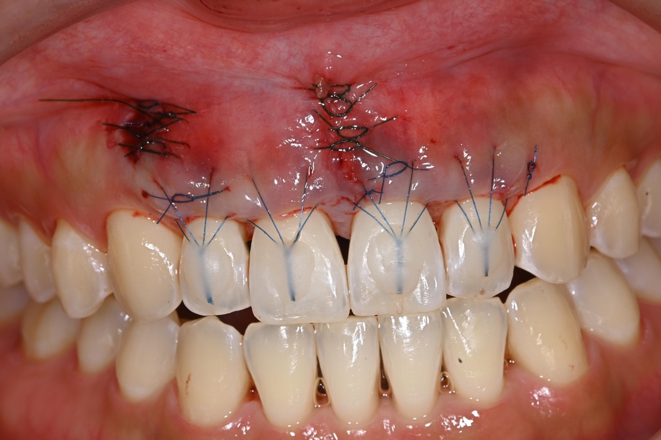 ☆即納☆世界で最も美しいサメ ヨシキリザメの歯 10本セット- 頭骨・骨格標本・剥製販売Core-Box