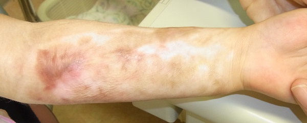 やけどの水ぶくれは何日で治る？薬や正しい対処法、応急処置を医師が解説！ - オンライン診療ならウチカラクリニック