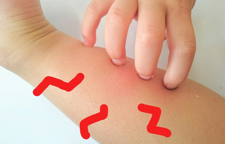 トコジラミとダニの症状の違いと見分け方！知っておくべき対処法神奈川県の駆除専門業者クリーン計画プロープル