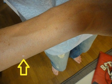 奥菜恵さん尋常性白斑を公表！体の色が抜けるってどんな症状？美味しく楽しい毎日