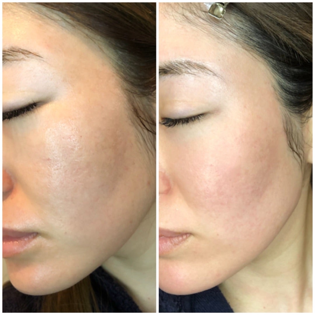 美容皮膚科ナースが教える！ 市販のセルフダーマペンのやり方は？効果とおすすめしない理由現役美容カウンセラーHAPIMARIのホンネブログ～美は1日にしてならず～