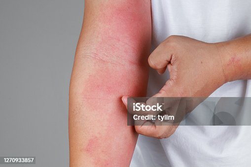 自己免疫性皮膚疾患 膠原病、血管炎、水疱症、円形脱毛症など皮膚科広島市立北部医療センター安佐市民病院