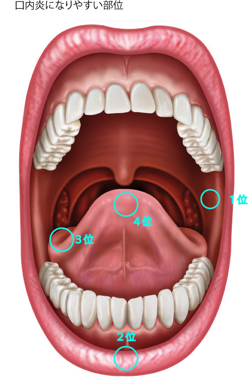 ニコチン性口内炎大東市・野崎駅前歯科クリニック・治療大解説