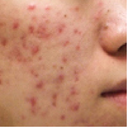 鼻のニキビ跡でもう悩まない！原因・種類・対策を徹底解説！フォーシーズンズ美容皮膚科クリニック美容コラム