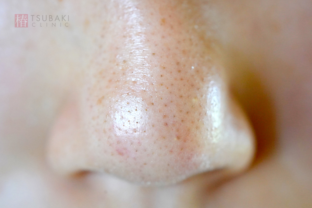 最新 鼻の角栓の正しい取り方とは？NGケア＆いちご鼻のケア方法まとめ美的.com