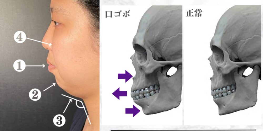 アデノイド顔貌」とは？子どもの顔立ちと健康に潜むサインを徹底解説