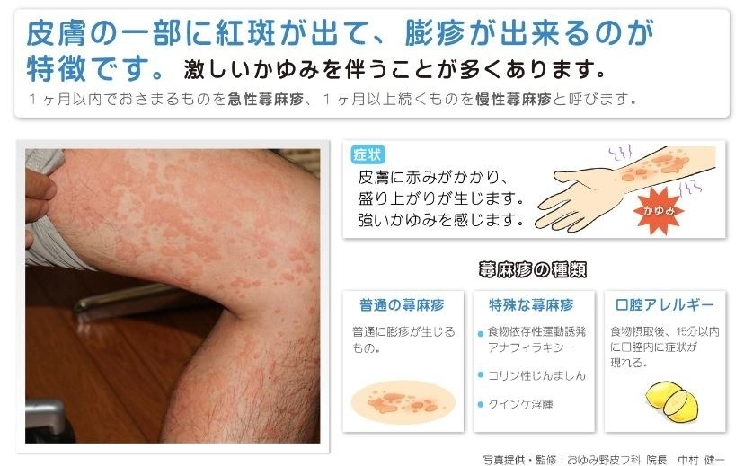 乳児のアトピー性皮膚炎