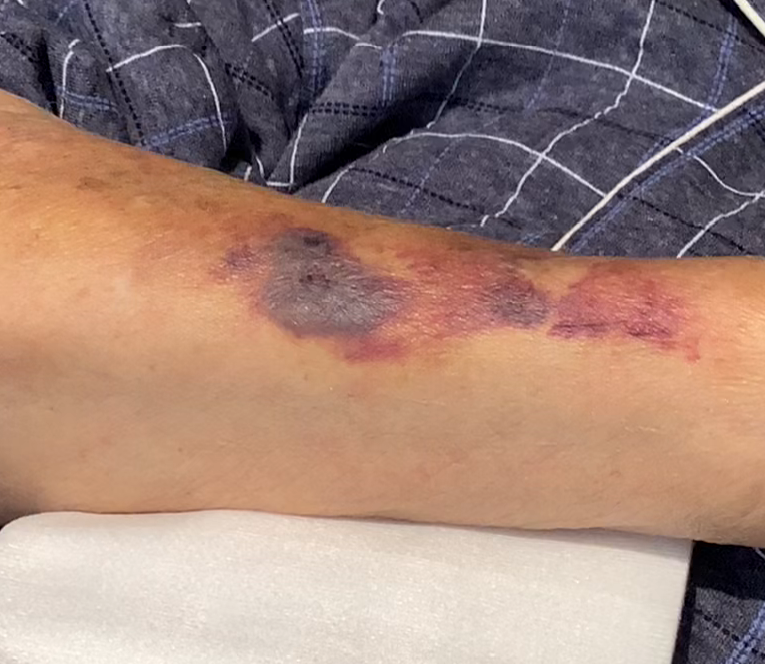 あざ 内出血 を早く治す方法を解説！治療期間や青や緑の色の違いは？ - 小林整骨院の体の悩み痛み改善コラム