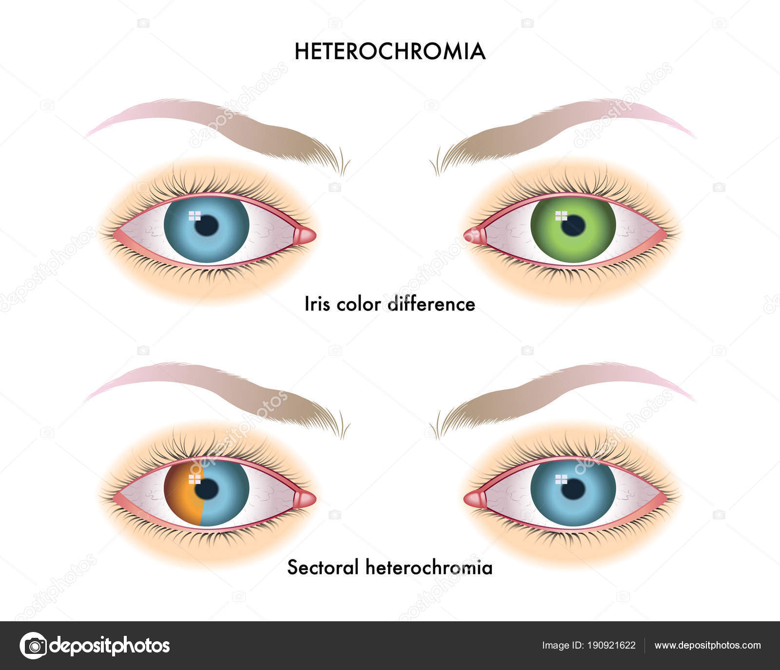 今度は虹彩異色症の人間を集めてみました。アトエクサ