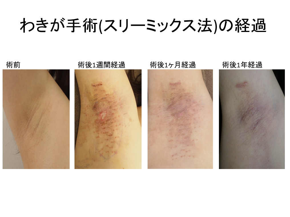 脇の白い塊の取り方 臭いブツブツはワキガのサインって本当？mocobe モコビ