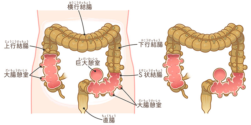 メッケル憩室 - Wikipedia
