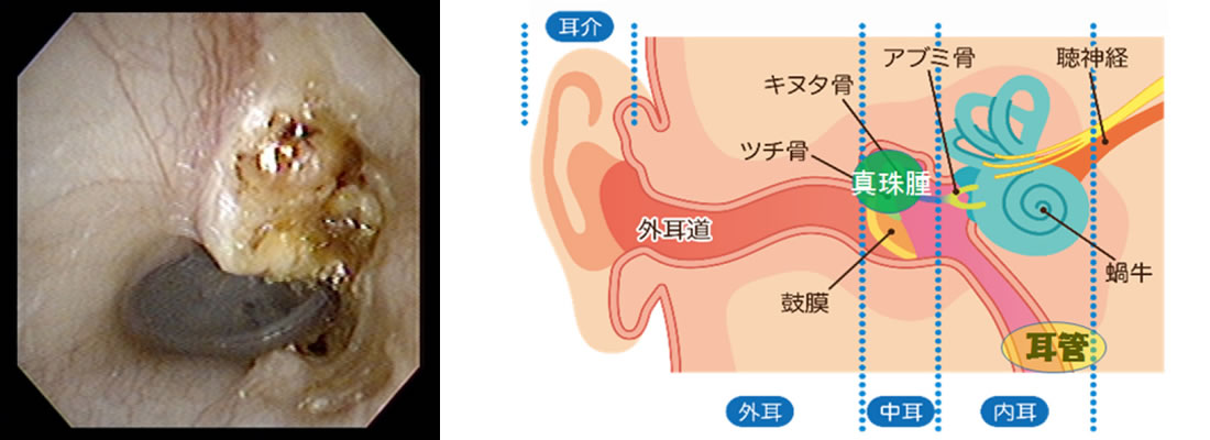 鼓室形成術 日帰り 慢性中耳炎の治療は大阪の「こにし耳鼻咽喉科」
