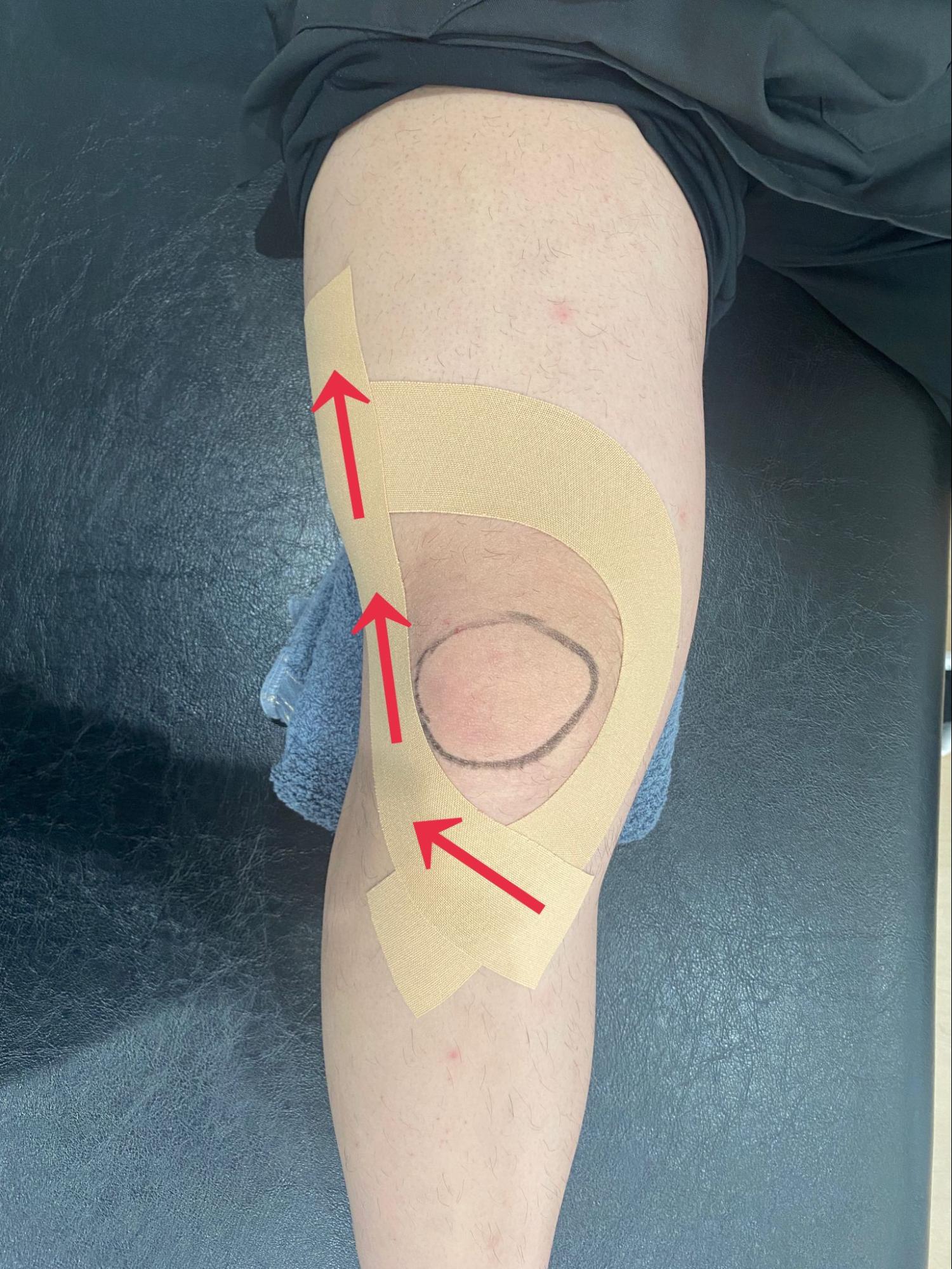 膝のテーピング⑧骨盤・肩甲骨はがしの大阪門真整体院