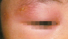 虫刺されによる紫のあざが・原因・治し方は？ イシャチョク