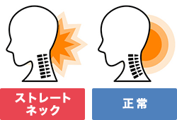 スマホ症候群 ストレートネック 鎌倉脳神経MRIクリニック鎌倉の頭痛と認知専門外来・MRI即日検査