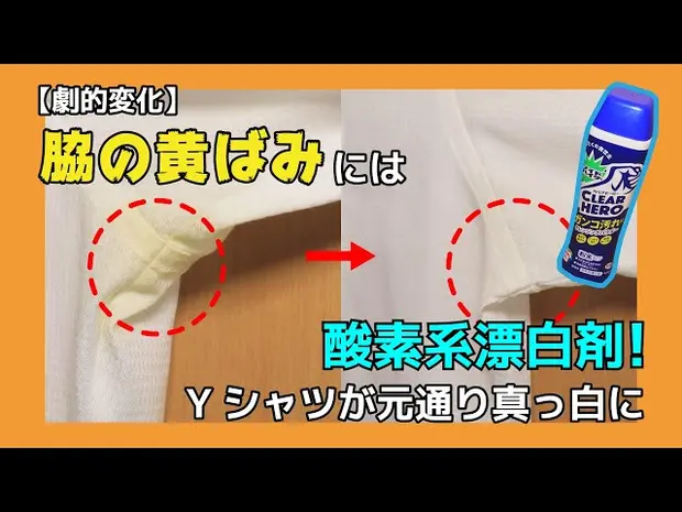 ワキガ 腋臭症 の治療〜ニオイの診断と手術～日本医科大学武蔵小杉病院