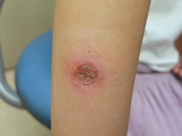 とびひってどんな病気？治療法や気をつける事は？プールに入ってもいいの？しいの木こどもクリニックブログ