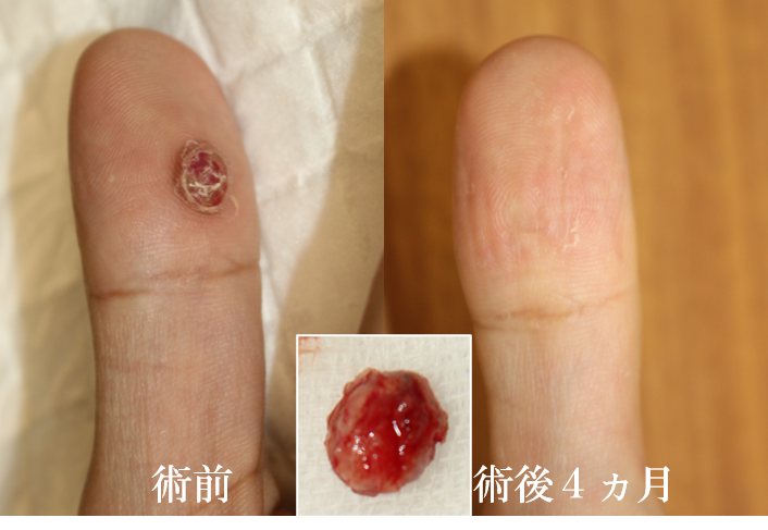 出血、化膿、肉芽 こんなトラブルは 皮膚科医の指示のもと 整えさせていただきます 看護師がおりますので 県内外の医師・病院と連携をとりながらケアさせて頂いております これが当院の強みの一つです 爪が欠けて 皮膚に当たって それが傷を作り 爪が伸びるごとに 歩く