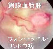 遺伝性褐色細胞腫 神経線維腫症1型 レックリングハウゼン病 ,フォン・ヒッペル・リンドウ病 長崎甲状