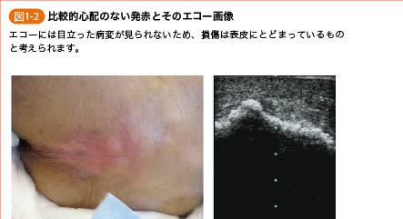 褥瘡のポケット形成について - 東御市民病院・東御市立みまき温泉診療所・東御市立助産所とうみ