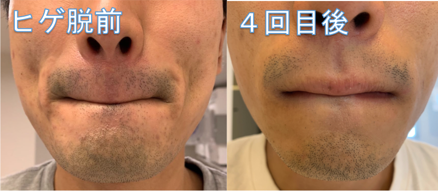 ヒゲを毛抜きで抜く癖による5つのデメリット！ - MuraBlog