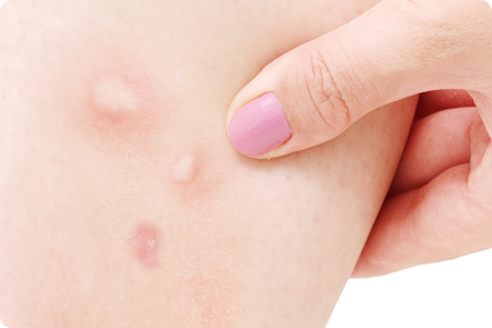 虫刺され』の症状・治療法 症例画像 田辺三菱製薬ヒフノコトサイト