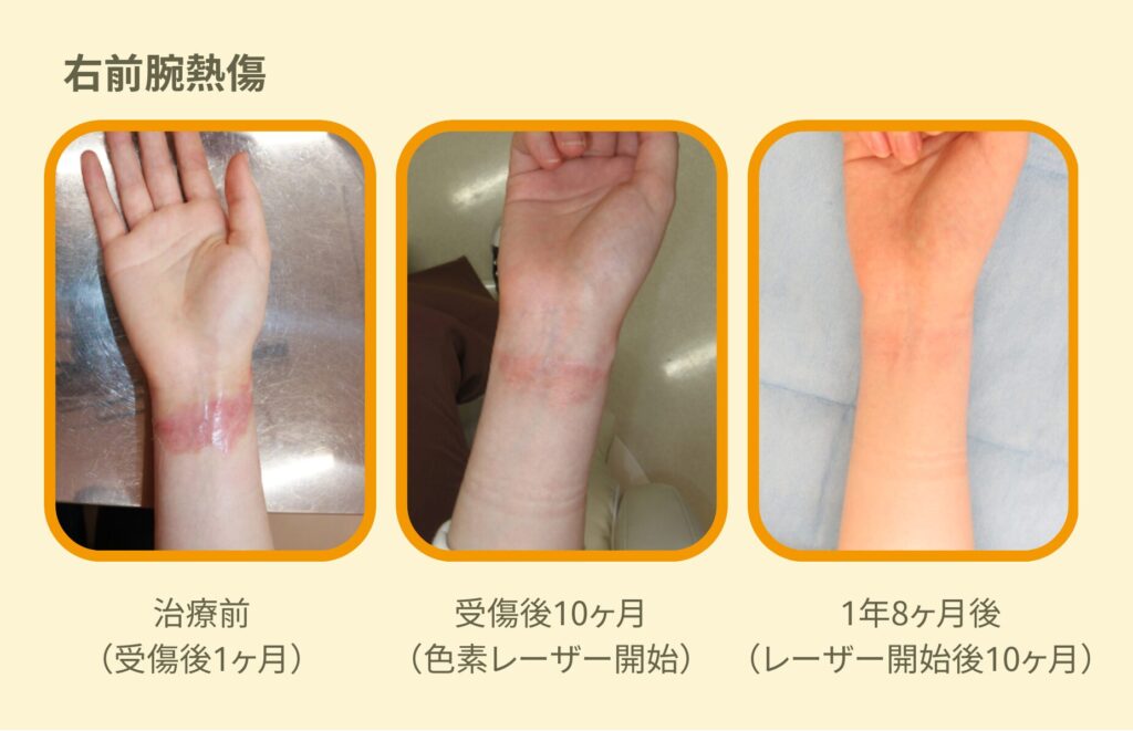 虫刺され Q5 - 皮膚科Q＆A 公益社団法人日本皮膚科学会