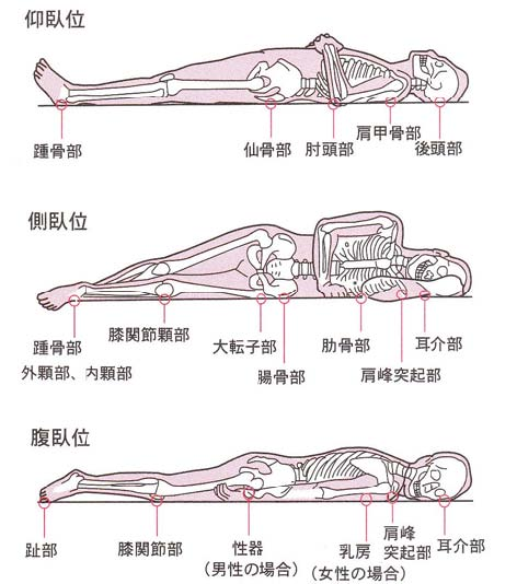褥瘡 床ずれ の予防について