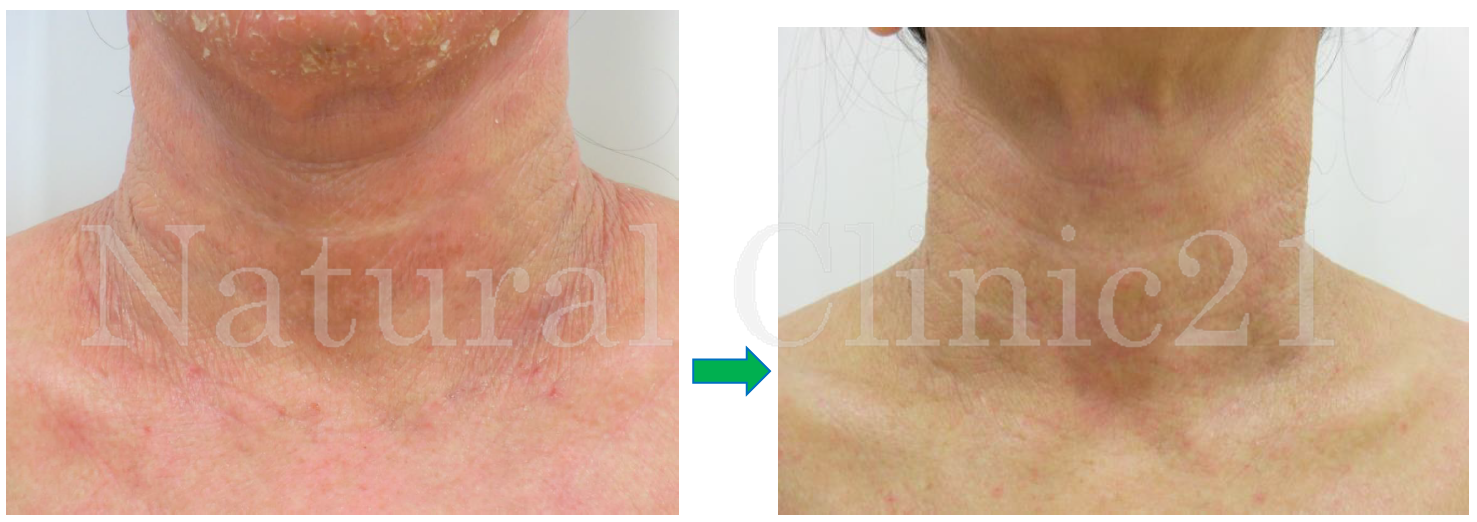 首がカサカサしてかゆい原因乾燥によるかゆみへの対処法と予防法を紹介乾燥肌治療薬ヒルマイルド健栄製薬