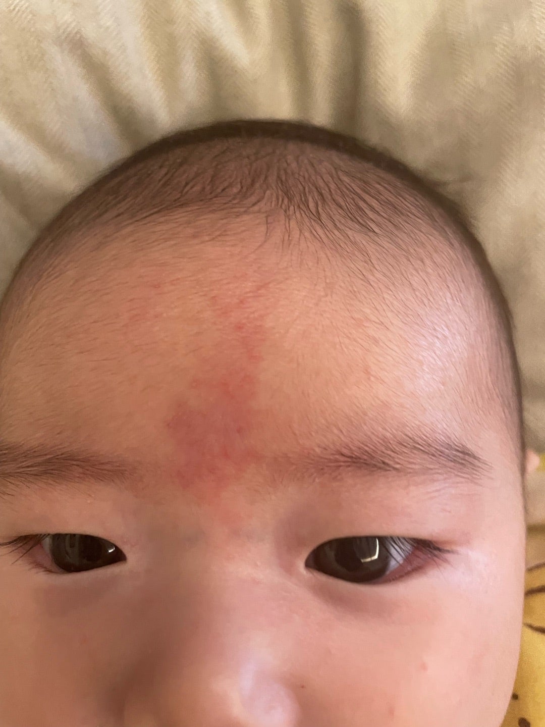 単純性血管腫 毛細血管奇形 赤あざ新橋汐留 小林クリニック あざ シミ レーザー治療