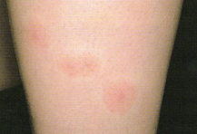 虫刺されの腫れが治らない時は？虫刺されの種類や薬について解説 ステロイド・リンデロンひまわり医院 内科・皮膚科