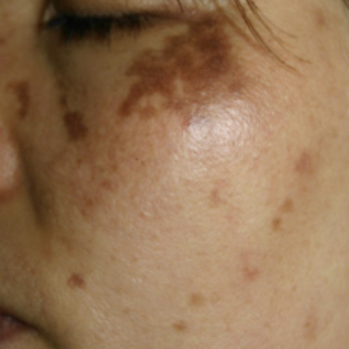 低色素沈着 - Wikipedia