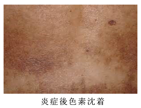 外傷性色素沈着症の治療船橋ゆーかりクリニック