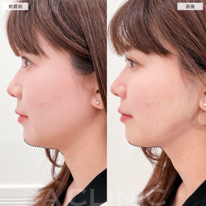 二重顎 名古屋に関するエステサロン lume beauty salon泉 ルーメビューティーサロン～美肌エイジングケア～などホットペッパービューティ