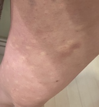 一般皮膚科：白斑 はくはん 平岡皮膚科スキンケアクリニック札幌市清田区